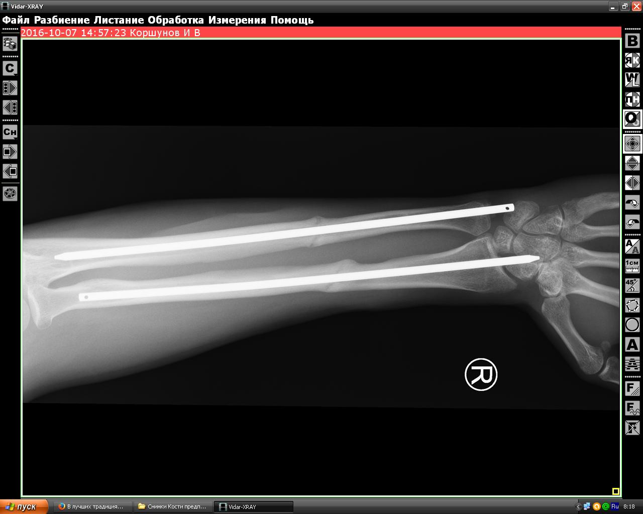 Серкляжный остеосинтез это. Перелом диафиза предплечья. Рентген оскольчатый перелом лучевой кости. Параметры линейного размера архикад. Петля со смещением оси открывания.